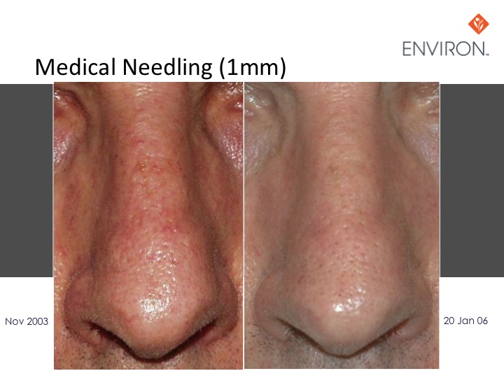 Medical Needling
