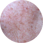 pigmentationImg