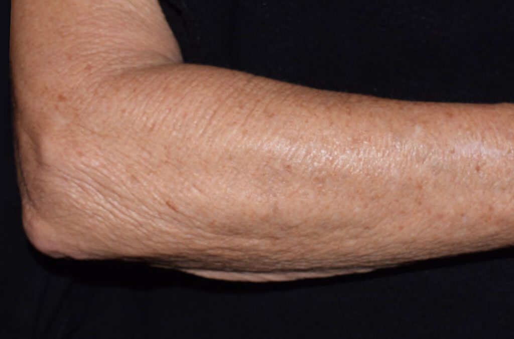 Cool Peel treatment for SUN-DAMAGED SKIN